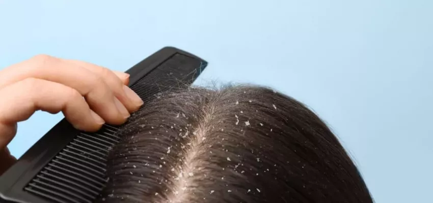 Saçları bakımsız gösteren kepeklerden kurtulmak sanıldığı kadar zor değil!