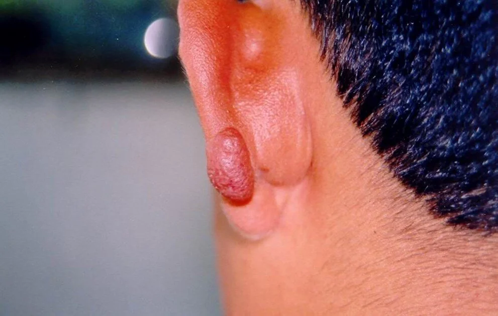 Kan emen kum sineği, dalakta ve karaciğerde büyümeye neden oluyor