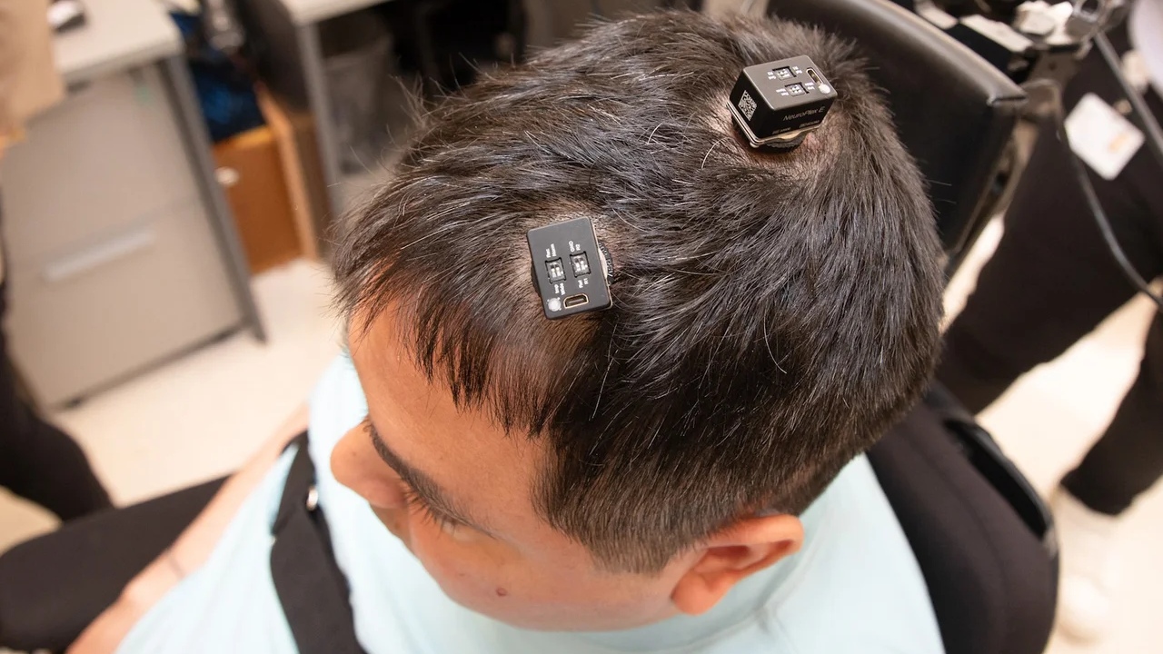 Beyne Yerleştirilen Yapay Zekâ Destekli Çip, Felçli Bir Adamın Kolunu Tekrar Hareket Ettirmesini Sağladı