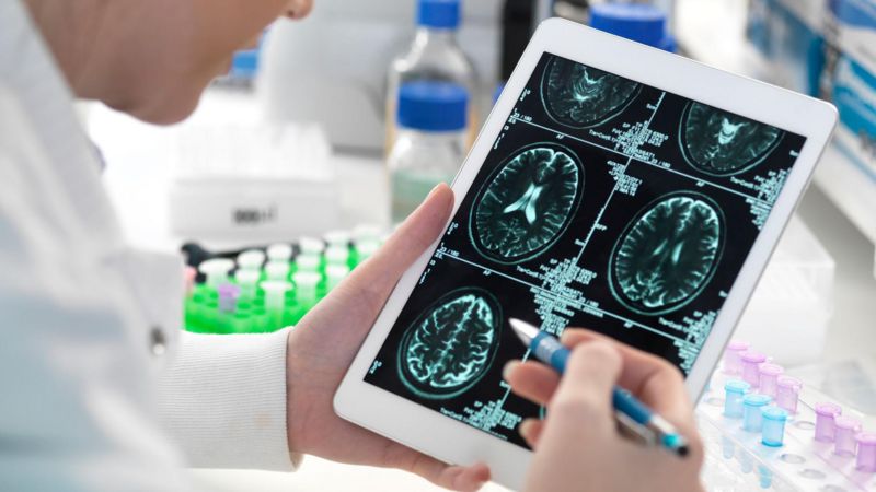 Bilim insanları Alzheimer hastalarında beyin hücrelerinin neden öldüğünü keşfetti