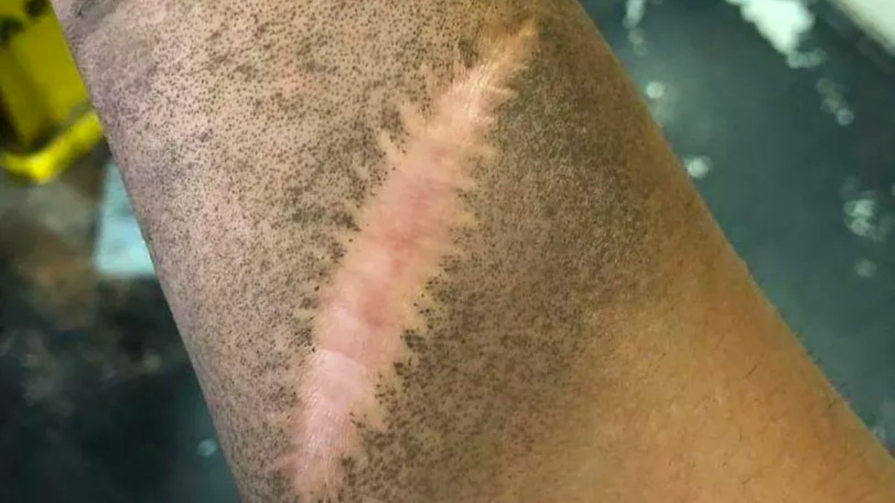 Şimdiye Dek Nasıl Fark Etmemişim Diyeceğiniz İlginç Gerçek: Yara İzleri Neden Toz Tutmaz?