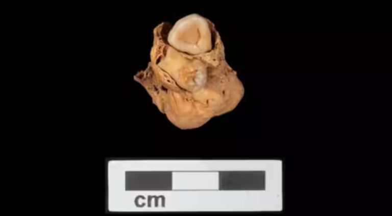 Nadir keşif: Eski Mısır mezarı, En Eski Teratom Örneğinde Yumurtalık Dişlerini Ortaya Çıkardı