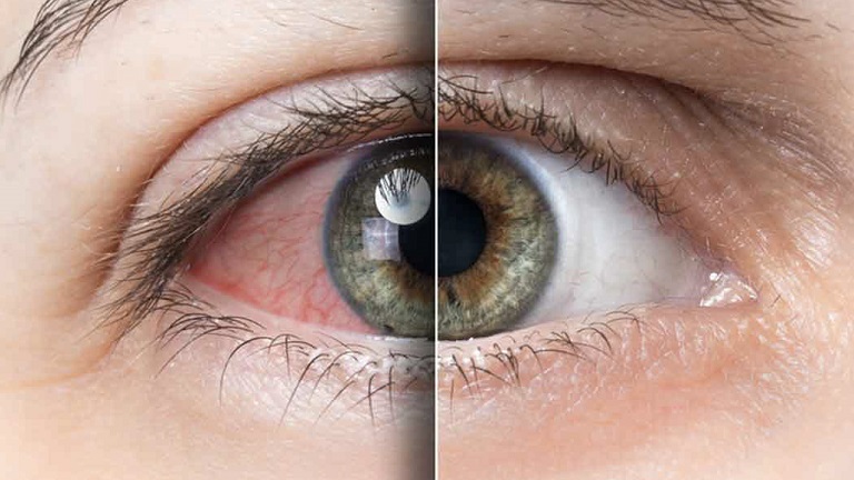 Gece Dayak Yemiş Gibi!.. Sabah Uyandığımızda Gözlerimiz Kan Çanağı Gibi..