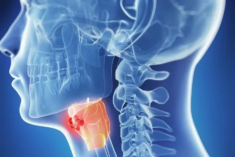 Gırtlak kanserinin en sık görülen belirtileri!