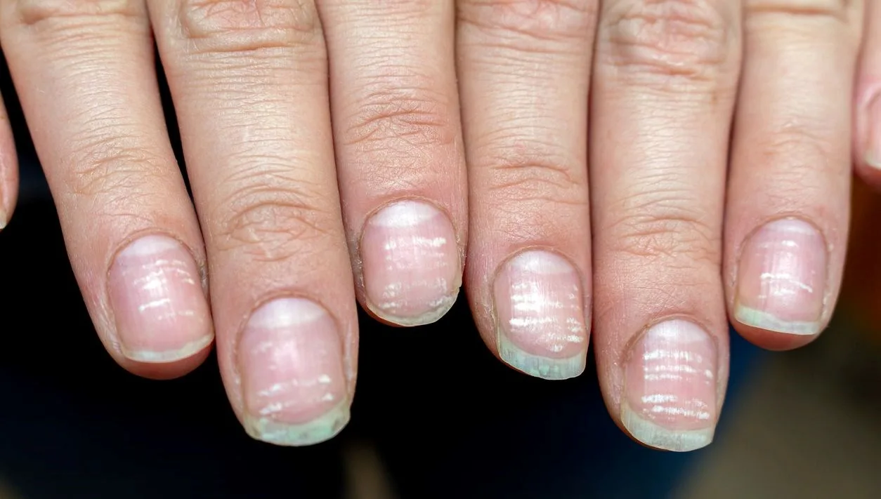 Tırnaklarda Beyaz Lekeler Neden Oluşur?