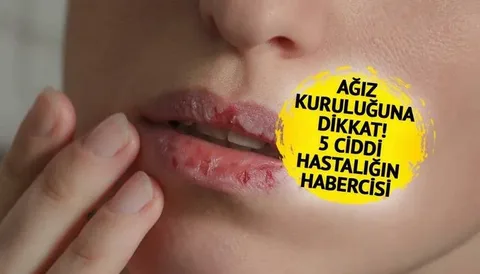 Ağız kuruluğu, ciddi bir sistemik hastalığın habercisi olabilir