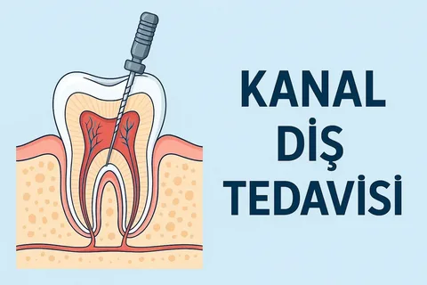 Kanal tedavisi dişin ömrünü uzatıyor!