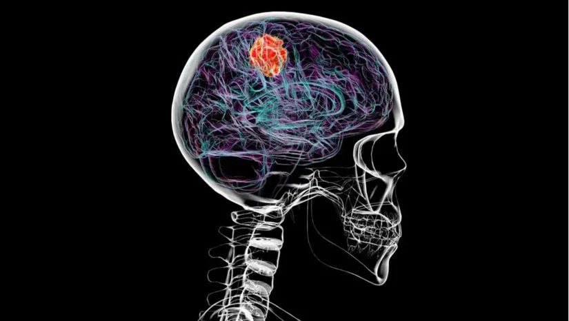 Beyin Kanseri, Kafatasının Bazı Kısımlarını Eritebilir!