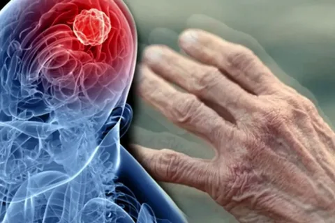Parkinson riskinde çevresel faktörler öne çıkıyor!