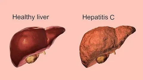 Hepatitler Hakkında Doğru Bilinen 11 Yanlış