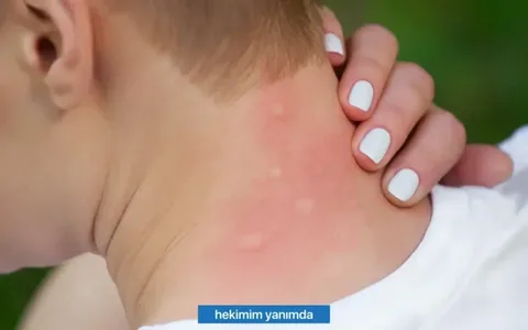 Yaz Sıcakları Kurdeşen Ataklarını Artırıyor