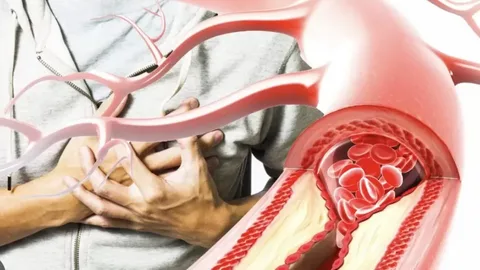 Damar Tıkanıklığında Antibiyotikle Tedavi Umudu: Damarları Bir Parazit Tıkıyor Olabilir