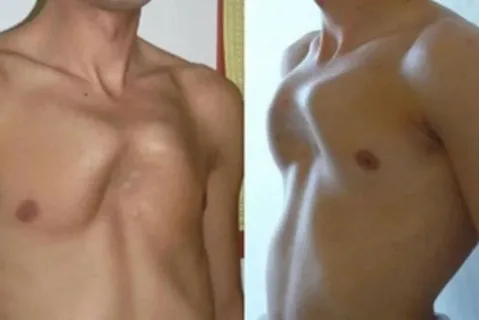 Çocuklardaki Göğüs Deformitelerini İhmal Etmeyin